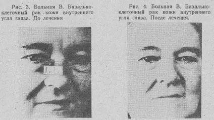 Злоякісні пухлини лікування магнітним полем (лікування) Злоякісні пухлини лікування магнітним полем