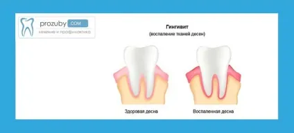 Зуби стають прозорими - причини і способи лікування (зуби) Зуби стають прозорими - причини і способи лікування