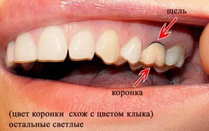 Зубний біль під коронкою що робити в домашніх умовах (домашніх) Зубний біль під коронкою що робити в домашніх умовах