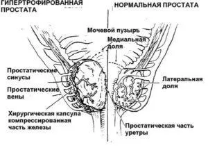 Альфа блокатори при аденомі простати - дія і ефективність (блокатори) Альфа блокатори при аденомі простати - дія і ефективність