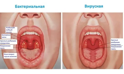 Ангіна у грудничка і новонародженого причини, симптоми, лікування (грудничка) Ангіна у грудничка і новонародженого причини, симптоми, лікування