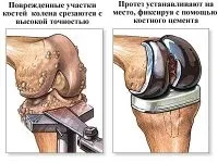 Артроз нижніх кінцівок лікування (суглобів нижніх кінцівок) Артроз нижніх кінцівок лікування