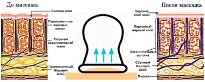 Апарат для банкового масажу для домашнього використання (апарат) Апарат для банкового масажу для домашнього використання