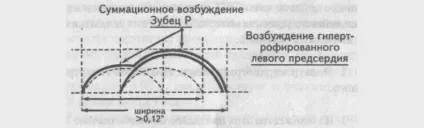 Подробиці про гіпертрофії правого передсердя