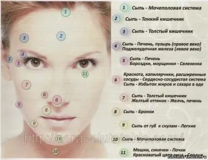 підшкірні вугри