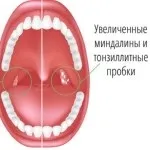 Біль в горлі з одного боку при ковтанні без температури (біль) Біль в горлі з одного боку при ковтанні без температури