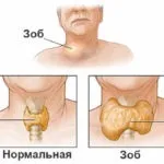Хвороба Хашимото - виявляємо і лікуємо (хвороба Грейвса основні) Хвороба Хашимото - виявляємо і лікуємо