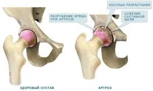 Біль в паху
