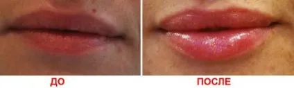 Ботокс в губи, збільшення губ ботоксом - наслідки, відгуки, фото, відео