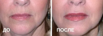 Ботокс губ особливості збільшення і скільки тримається (підняти куточки губ ботоксом) Ботокс губ особливості збільшення і скільки тримається