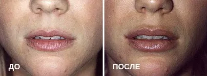 Ботокс губ особливості збільшення і скільки тримається (скільки) Ботокс губ особливості збільшення і скільки тримається