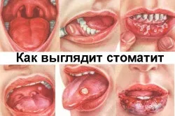 Чим стоматит відрізняється від молочниці (відрізняється) Чим стоматит відрізняється від молочниці