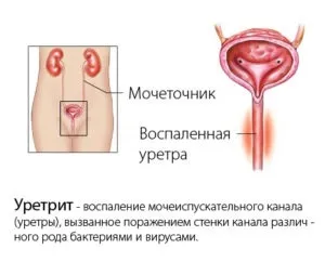 Що корисно, що не можна при циститі список, меню (корисно) Що корисно, що не можна при циститі список, меню