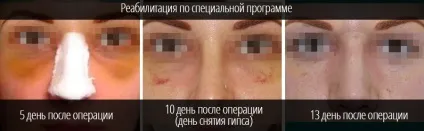 Що можна і що не можна робити після ринопластики носа (робити) Що можна і що не можна робити після ринопластики носа