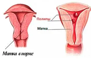 Що таке поліпи в матки і звідки вони беруться (поліпи) Що таке поліпи в матки і звідки вони беруться