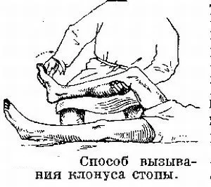 Що таке клонуси стоп і колінних чашечок причини, діагностика та лікування (клонуси стоп і колінних чашечок) Що таке клонуси стоп і колінних чашечок причини, діагностика та лікування