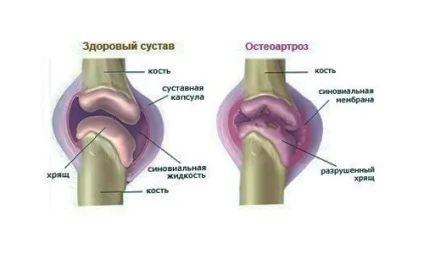 Деформуючий остеоартроз суглобів стопи ступеня, симптоми, лікування, народні засоби (стопи) Деформуючий остеоартроз суглобів стопи ступеня, симптоми, лікування, народні засоби