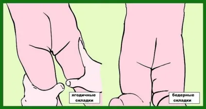 Дисплазія тазостегнових суглобів причини, симптоми, лікування (тазостегнових) Дисплазія тазостегнових суглобів причини, симптоми, лікування