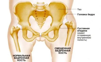 Дисплазія тазостегнових суглобів причини, симптоми, лікування (суглобів) Дисплазія тазостегнових суглобів причини, симптоми, лікування