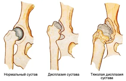 Дисплазія тазостегнових суглобів причини, симптоми, лікування (причини) Дисплазія тазостегнових суглобів причини, симптоми, лікування