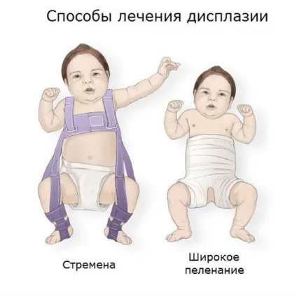 Дисплазія тазостегнових суглобів причини, симптоми, лікування (дисплазія тазостегнових суглобів) Дисплазія тазостегнових суглобів причини, симптоми, лікування