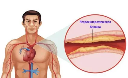 Доведено! Як позбавитися від атеросклерозу судин