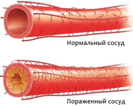 Доведено! Як позбавитися від атеросклерозу судин