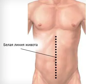 Епігастральній грижа, причини утворення та симптоми