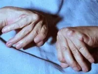 Поліартрит лікування народними засобами (лікування хвороб суглобів) Поліартрит лікування народними засобами