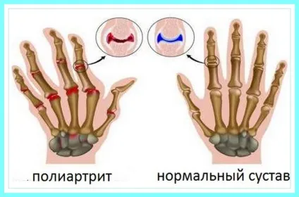 Поліартрит пальців рук лікування народними засобами (лікування) Поліартрит пальців рук лікування народними засобами