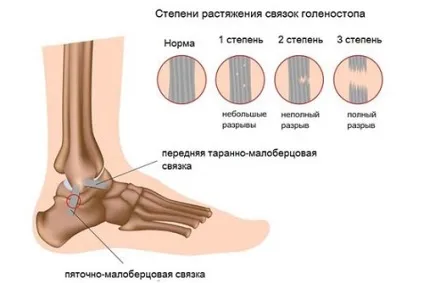Показання до проведення МРТ стопи і гомілковостопного суглоба