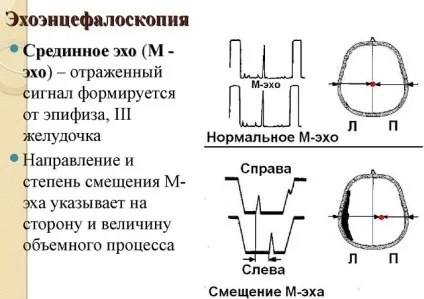 Ехоенцефалоскопія головного мозку (ЕхоЕС) показання, розшифровка результатів (ехоенцефалоскопія) Ехоенцефалоскопія головного мозку (ЕхоЕС) показання, розшифровка результатів