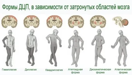 Форми і види ДЦП (атонически астатическая, спастична, гіперкінетична і інші) (астатическая) Форми і види ДЦП (атонически астатическая, спастична, гіперкінетична і інші)
