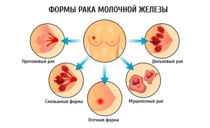 Форми раку молочної залози, компетентно про здоров'я на ilive (залози) Форми раку молочної залози, компетентно про здоров'я на ilive