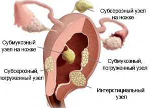 Де розташований інструментально субсерозний вузол, лікування патології