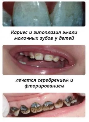 Гіпоплазія емалі зубів причини, лікування і профілактика (гіпоплазія емалі зубів) Гіпоплазія емалі зубів причини, лікування і профілактика