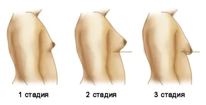 Гінекомастія у підлітків 12-15 років (гінекомастія) Гінекомастія у підлітків 12-15 років