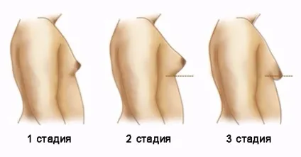 Гінекомастія у чоловіків (справжня й хибна) причини і симптоми, лікування без операції, видалення, (причини) Гінекомастія у чоловіків (справжня й хибна) причини і симптоми, лікування без операції, видалення,