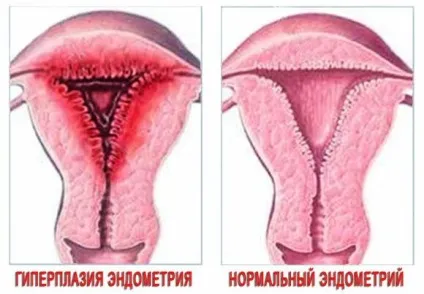Гіперплазія ендометрію це рак чи ні (ендометрія) Гіперплазія ендометрію це рак чи ні