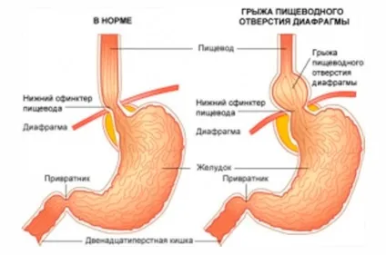 Грижа стравохідного отвору діафрагми (діафрагмальна грижа) симптоми і лікування (стравохідного) Грижа стравохідного отвору діафрагми (діафрагмальна грижа) симптоми і лікування