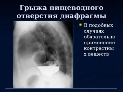 Грижа стравохідного отвору діафрагми (діафрагмальна грижа) симптоми і лікування (діафрагми) Грижа стравохідного отвору діафрагми (діафрагмальна грижа) симптоми і лікування