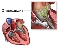Інфекційний ендокардит - симптоми і лікування (ендокардит) Інфекційний ендокардит - симптоми і лікування