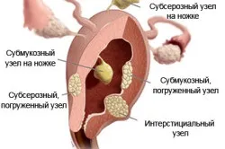 Інструментально субсерозний вузол
