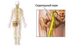 Ішіас - причини, симптоми і лікування в домашніх умовах і медикаментозне
