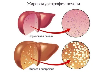 Інтоксикація печінки симптоми, ознаки, лікування, наслідки (симптоми) Інтоксикація печінки симптоми, ознаки, лікування, наслідки