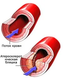 Як позбавиться від атеросклерозу - лікування серця