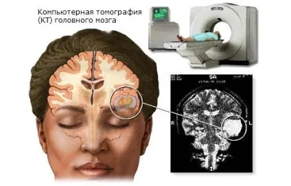 Як досліджують головний мозок методом комп'ютерної томографії (томографії) Як досліджують головний мозок методом комп'ютерної томографії