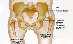 Допомога при вивиху кульшового суглоба у дорослих причини, симптоми, лікування (дорослих) Допомога при вивиху кульшового суглоба у дорослих причини, симптоми, лікування