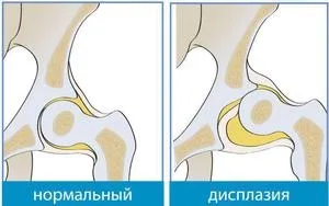 Допомога при вивиху кульшового суглоба у дорослих причини, симптоми, лікування (симптоми) Допомога при вивиху кульшового суглоба у дорослих причини, симптоми, лікування