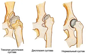 Допомога при вивиху кульшового суглоба у дорослих причини, симптоми, лікування (суглоба) Допомога при вивиху кульшового суглоба у дорослих причини, симптоми, лікування
